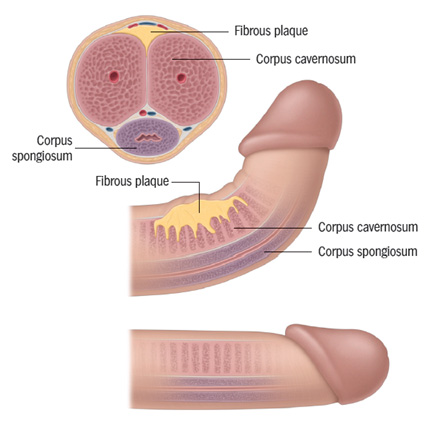 Peyronie’s disease with penile curvature